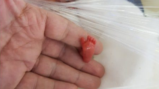 Nu o să-ţi vină să crezi cum arată Lyla, cel mai prematur bebeluş din lume! S-a născut la doar cinci luni şi a supravieţuit miraculos