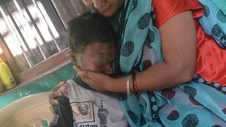 "Fata-sarpe"- Isi exfoliaza pielea la fiecare 6 saptamani din cauza unei boli rare. Pentru ca arata asa, fata de 16 ani a fost data afara de la scoala