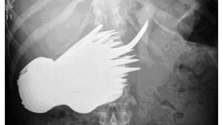 A ajuns la spital cu dureri cumplite de burta, iar medicii s-au inchinat cand au vazut radiografia. "Doamna, sunt 78...cum de mai traiti?"