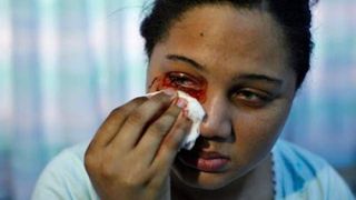 Misterul medical! O femeie transpira sange pe anumite parti ale corpului. Ce spun specialistii