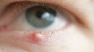 Credea ca are o geana in ochi. S-a ingrozit cand a verificat si a aflat ce are acolo - Ai grija mare si tu