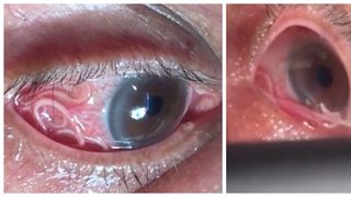 Avea o creatură ciudată &icirc;n ochi! Medicii au fost şocaţi c&acirc;nd au văzut ce scot din ochiul unui bărbat!