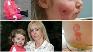 Şi-a lăsat fetiţa într-un loc de joacă, iar când s-a întors de la cumpărături a avut un şoc! A fost muşcată de 15 ori de către alţi copii! Micuţa a rămas cu cicatrici pe viaţă!