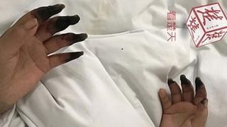 O femeie s-a trezit cu opt dintre degetele de la m&acirc;nă &icirc;nnegrite dintr-o dată. Boala de care suferă! Nu se aștepta la așa ceva 