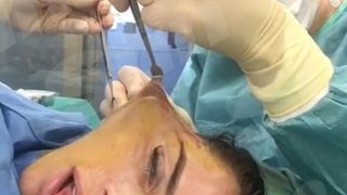 Vedeta TV, imagini &Icirc;NGROZITOARE din timpul unui lifting facial! A filmat tot! Fanii au luat foc