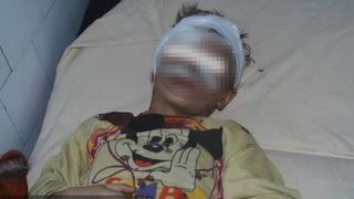 Vaslui. Copilul mușcat de câine, operat cu chiu cu vai. Părinții au uitat nasul smuls, necesar pentru reconstrucție, pe bancheta mașinii