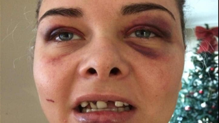 Femeie desfigurată de iubit după ce și-a schimbat poza de pe Facebook: "Unul dintre dinți mi-a ajuns &icirc;ntr-o nară"