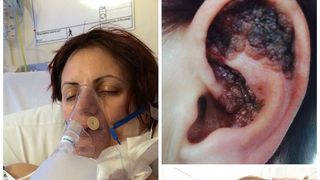 S-a ales cu cancer și cu urechea amputată din cauza unui obicei preferat de rom&acirc;nce! "Așa ceva trebuie INTERZIS!" - E cumplit prin ce chinuri a trecut această femeie!