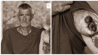 Leonard a trăit 10 ani cu o anomalie pe umăr! Ce l-a făcut să arate așa? Medicii au reușit să îl trateze! "Ajunsesem să îi pun și nume. Nici nu realizez că acum nu mai este!"