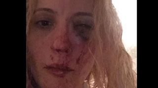 Povestea dramatică a Ancăi, româncă desfigurată de 10 minori în fața casei din Anglia. "Niciun vecin nu a ieșit