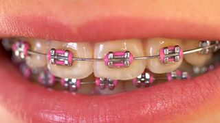 VIDEO | Aparatul dentar a devenit OBIECT ESTETIC! E deja o fiță să te afișezi la evenimente cu așa ceva