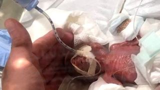 Cum arată cel mai mic nou-născut din lume! Băiețelul a c&acirc;ntărit 258 de grame la naștere