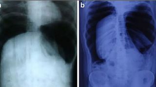 I-a explodat colonul după o farsă făcută de prieteni! Este &icirc;nfiorător prin ce chinuri a trecut un t&acirc;năr de 30 de ani