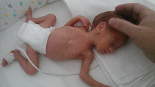 Bebelușul de 720 de grame a murit 