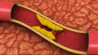 Cum îţi poţi curăţa vasele de sânge de colesterol în doar 40 de zile