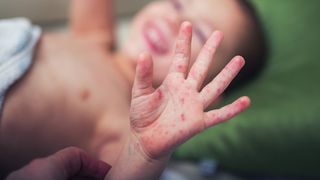 Boala &rdquo;m&acirc;nă-gură-picior&rdquo; face ravagii &icirc;n Rom&acirc;nia. Care sunt primele simptome