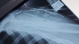 Un medic din Botoșani, îngrozit după ce i-a făcut o radiografie unui pacient: "În 40 de ani nu am văzut aşa ceva"