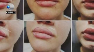 VIDEO | Tinere mutilate de o femeie care pretinde că este medic estetician. Specialist: &bdquo;Se poate ajunge la orbire, la necroze masive&rdquo;