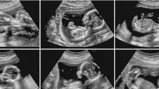 Particule din aerul poluat, descoperite &icirc;n placente. Cum &icirc;i afectează pe bebeluși?