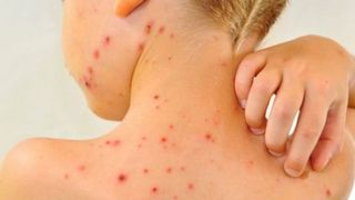 Alte 53 de cazuri nou-confirmate de rujeolă au fost raportate &icirc;n ultima săptăm&acirc;nă