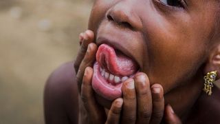 Semnal de alarmă pentru părinți. Unul din trei copii din lume este malnutrit sau supraponderal