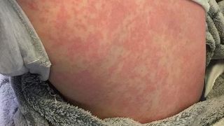 Cazul șocant al copilului alergic la iarnă. Ce reacție &icirc;i provoacă frigul