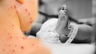 VIDEO | Epidemie de rujeolă &icirc;n Rom&acirc;nia. Pentru copiii nevaccinați, riscurile sunt uriașe! Avertismentul medicului Mihai Craiu