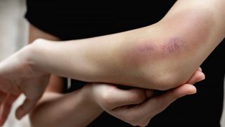 O elevă de liceu se teme să mai meargă la școală după ce a fost bătută de o colegă care i-a smuls părul din cap