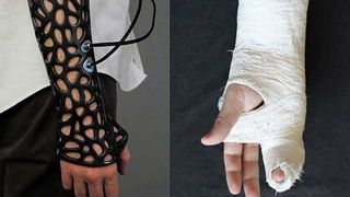 Tehnologia ne uimește din nou. Nu mai ai nevoie de ghipsul tradițional - gipsul 3D grăbește vindecarea prin ultrasunete