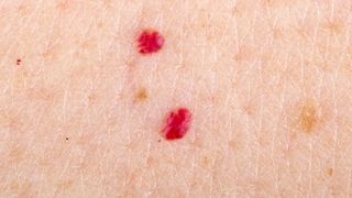 Alunite rosii. Ce sunt alunitele rosii? De ce apar alunitele rosii