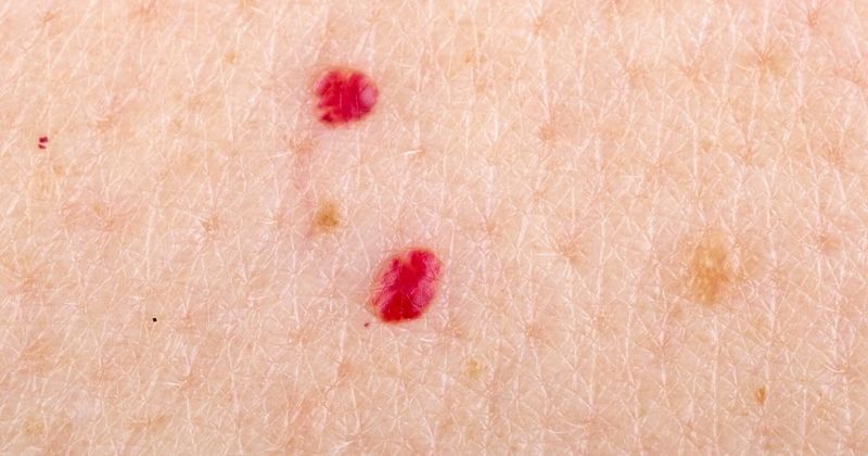 Alunite rosii. Ce sunt alunitele rosii? De ce apar alunitele rosii