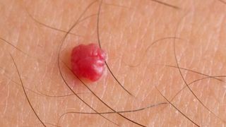 I-au apărut are câteva ALUNIŢE ROŞII pe corp şi s-a dus la medic. ÎNGROZITOR! Ce i-a spus doctorul