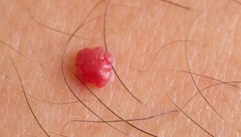 Alunite rosii. Ce sunt alunitele rosii? De ce apar alunitele rosii