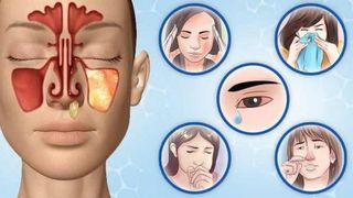 Sinuzita tratament naturist