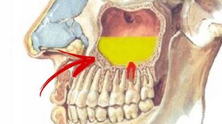 Sinuzita tratament naturist