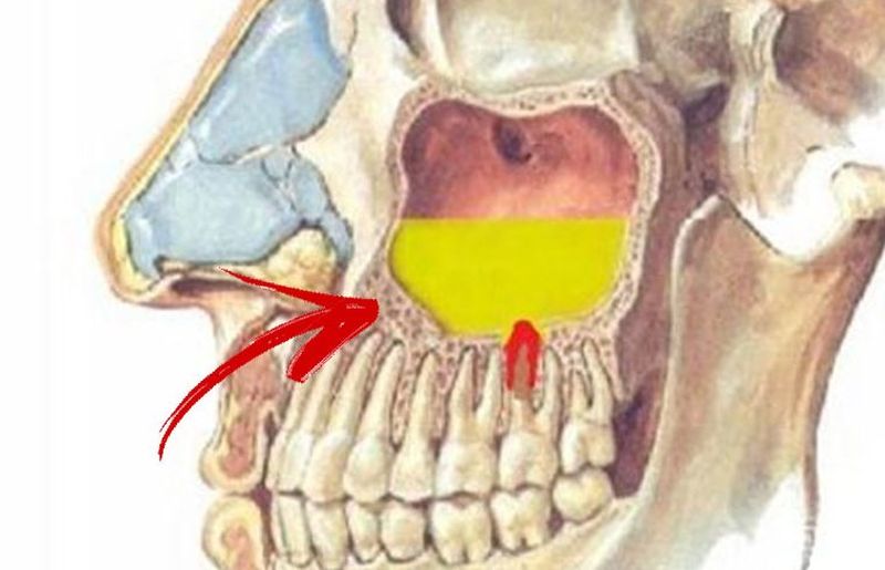 Sinuzita tratament naturist