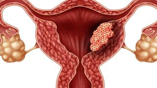 Cancer de col uterin. Cancer de col uterin tratament. Cancerul de col uterin. Cancer de col uterin simptome. Cancer de col uterin stadii. Simptome cancer de col uterin. HPV. Virusul HPV