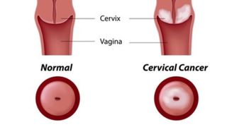 Cancer de col uterin. Cancer de col uterin tratament. Cancerul de col uterin. Cancer de col uterin simptome. Cancer de col uterin stadii. Simptome cancer de col uterin. HPV. Virusul HPV