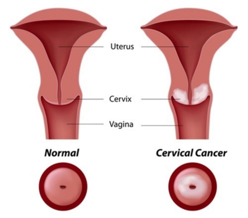Cancer de col uterin. Cancer de col uterin tratament. Cancerul de col uterin. Cancer de col uterin simptome. Cancer de col uterin stadii. Simptome cancer de col uterin. HPV. Virusul HPV