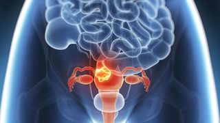 Cancer de col uterin. Cancer de col uterin tratament. Cancerul de col uterin. Cancer de col uterin simptome. Cancer de col uterin stadii. Simptome cancer de col uterin. HPV. Virusul HPV