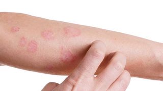 Psoriazis. Cauza psoriazis. Psoriazis tratament