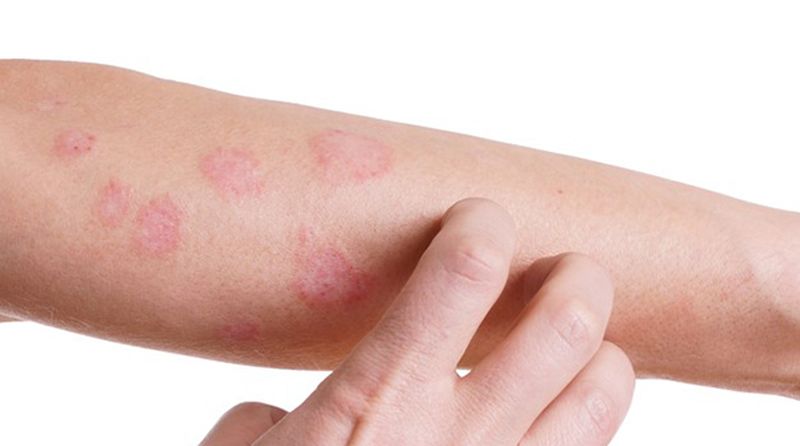 Psoriazis. Cauza psoriazis. Psoriazis tratament