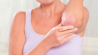 Psoriazis. Cauza psoriazis. Psoriazis tratament