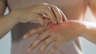 Psoriazis. Cauza psoriazis. Psoriazis tratament