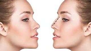 Cum să te refaci mai repede după o rinoplastie?