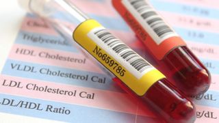 Ce sunt, de fapt, trigliceridele? Adevărul pe care doctorii evită să îl spune