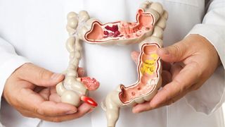  Cancerul de colon - Simptome cancer de colon - cauze cancer de colon