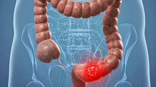  Cancerul de colon - Simptome cancer de colon - cauze cancer de colon