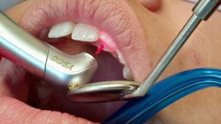 Cariile pot fi tratate azi și fără durere, fără anestezie