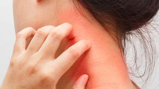 Ce este dermatomiozita, boala cruntă de care suferă Sorina Pintea?